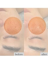 ダリアビューティー(Dahlia Beauty)/ビオフィートbefore after