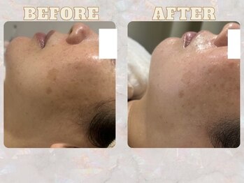 パンジー 上野フェイシャルエステ専門店(pansy)/*フェイシャル/ニキビケア*