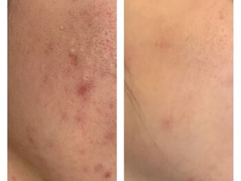 エスツリービューティーアンドネイル(S-TREE BEAUTY&NAIL)/【毛穴】ビフォーアフター