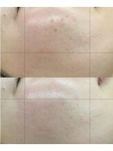 エスボーテ(sbeaute)/根本的な肌質改善