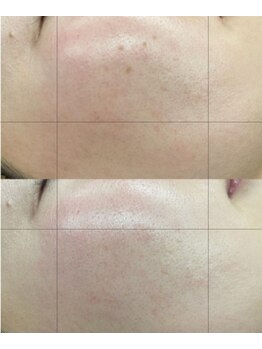 エスボーテ(sbeaute)/根本的な肌質改善