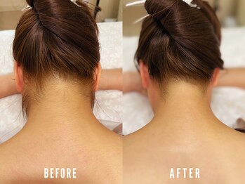 ビーグラム(B.GLAM)/シュガーリング×光脱毛／うなじ