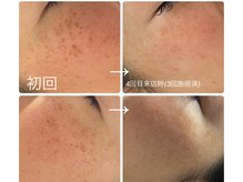 モフ(mof.)/Pigwii シミケアでクリアな肌へ