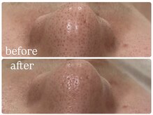 ビノスビューティー(vinos.beauty)/毛穴洗浄/ハーブピーリング/小顔