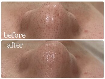 ビノスビューティー(vinos.beauty)/毛穴洗浄/ハーブピーリング/小顔