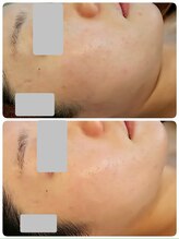 デイスパ コオリナ(DAYSPA Ko olina)/毛穴レス肌◎フェイスライン◎