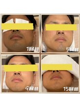 テトテ(tetote)/ヒゲ脱毛