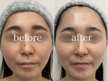 ルテア(Retea.)/REVIハーブピーリング