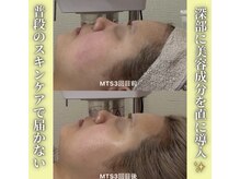 ハニエル(Haniel)/無針水光注入症例