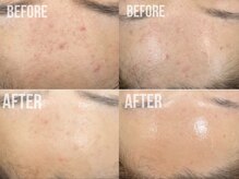 煌(kirameki)/【ニキビ】毛穴洗浄＋micostella