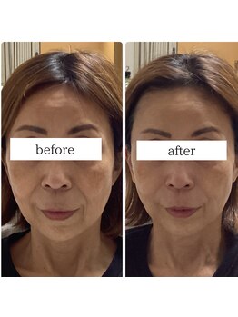 アキの写真/疲れて見える印象を若々しく◇表情筋を鍛える【たるみ改善ケア】自然で若々しい印象へ