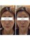 アキの写真/疲れて見える印象を若々しく◇表情筋を鍛える【たるみ改善ケア】自然で若々しい印象へ