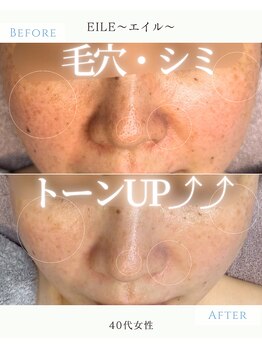 エイル(EILE)の写真/明るい肌へ！美白ケアとシミ対策でトーンアップ。肌質改善で毛穴も整う♪