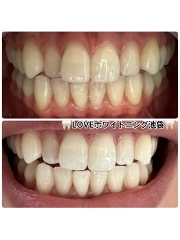 ラブホワイトニング 渋谷店(LOVEホワイトニング)/初回2回照射ホワイトニング