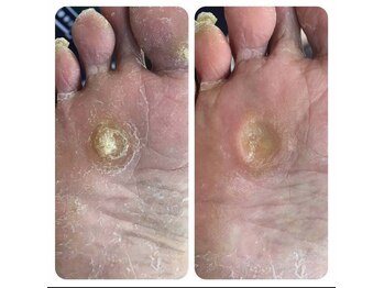 事例【ドイツ式フットケア】