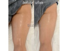 グレアージュ(GLEAGE)/全身痩身凹凸脂肪コース！