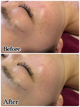 ルル 北仙台/お客様Before/After　美白　