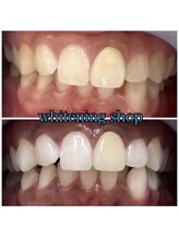 ホワイトニングショップ 池田店/【BEFORE/AFTER】