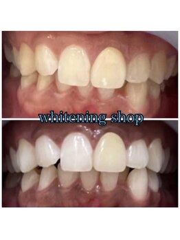 ホワイトニングショップ 池田店/【BEFORE/AFTER】