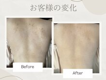 アイル 金山店(iru)の雰囲気（背中の剥離ありハーブピーリング5回目のお客様）