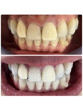 ラブホワイトニング 渋谷店(LOVEホワイトニング)/初回２回照射ホワイトニング