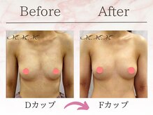 エムエムエム 表参道Luxeサロン(M.M.M)/【バストアップ例】　D→Fカップ