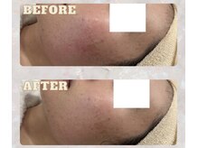 パンジー 上野フェイシャルエステ専門店(pansy)/*フェイシャル/ニキビケア*