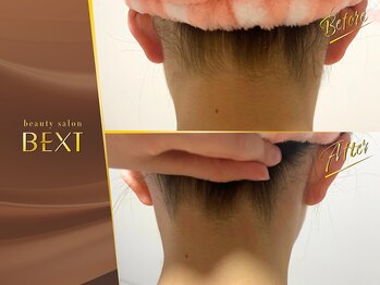 ベクスト(BEXT)/うなじ脱毛(PRO)