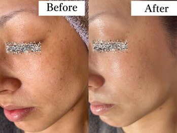 サロン ド エン(Salon de. en)/シミケア◇ハーブピーリング