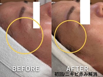 ラカ 明石(Laka)/繰り返す頑固なニキビケア