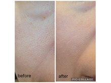 1度でも結果がわかる！幹細胞導入フェイシャル。毛穴・たるみ