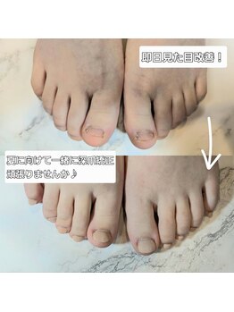 サロン ド コロレ/フット【深爪】夏までに改善♪