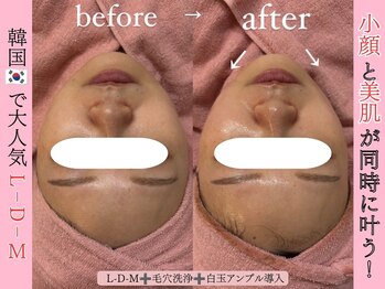 エン クリニカルラボ 心斎橋店(E&N CLINICAL LABO)/L-D-Mパッケージ/小顔たるみ