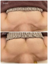 美人バスト 豊橋店/バストアップ症例【バストケア】