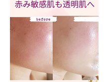 プライベートサロン 美月/赤み　敏感肌も透明肌