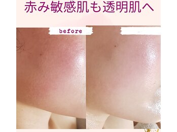 プライベートサロン 美月/赤み　敏感肌も透明肌