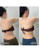 ヴィーナス(Venus)/ブライダル痩身　3回