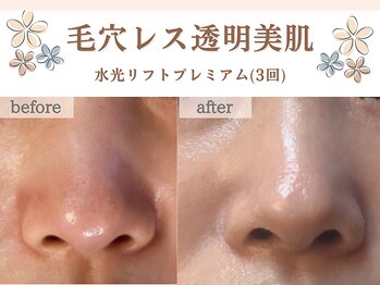 ミトラ(MITRA)/水光リフトfacial3回でツヤ美肌