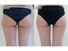 ブリエル(BRILLER)/脂肪冷却（お尻）