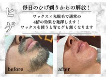 アルゴ 柳川店(ALGO)/【ヒゲ脱毛】毎日の髭剃り卒業