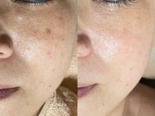 ゾーンビューティーハウス 柏店(ZONE BEAUTY HOUSE)/☆シミが気になる方も☆