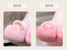 ルポ 伊勢/巻き爪ケア