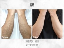 ベル(Belle)/メンズ腕脱毛