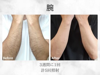 ベル(Belle)/メンズ腕脱毛