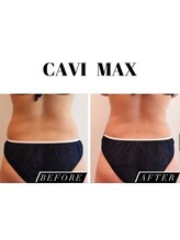 ファロンビューティー(fallon beauty)/痩身ビフォーアフター