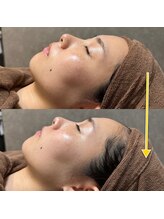 ベラノーブル(bella noble)/before/after