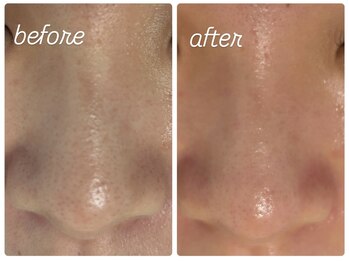 サロン マレ(salon mare)/毛穴洗浄