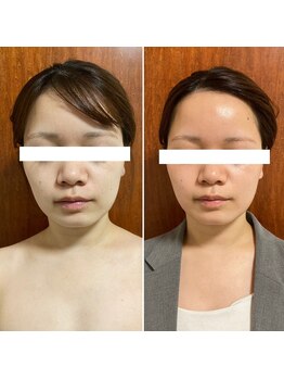 ニコワ(Nicowa)/Nicowaのコルギ★BeforeAfter