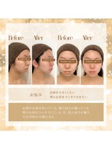 美容整骨小顔ラボ/ビフォーアフター