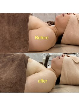 ベッピン(Beppin)/1回/サイドのハリ/ボリューム